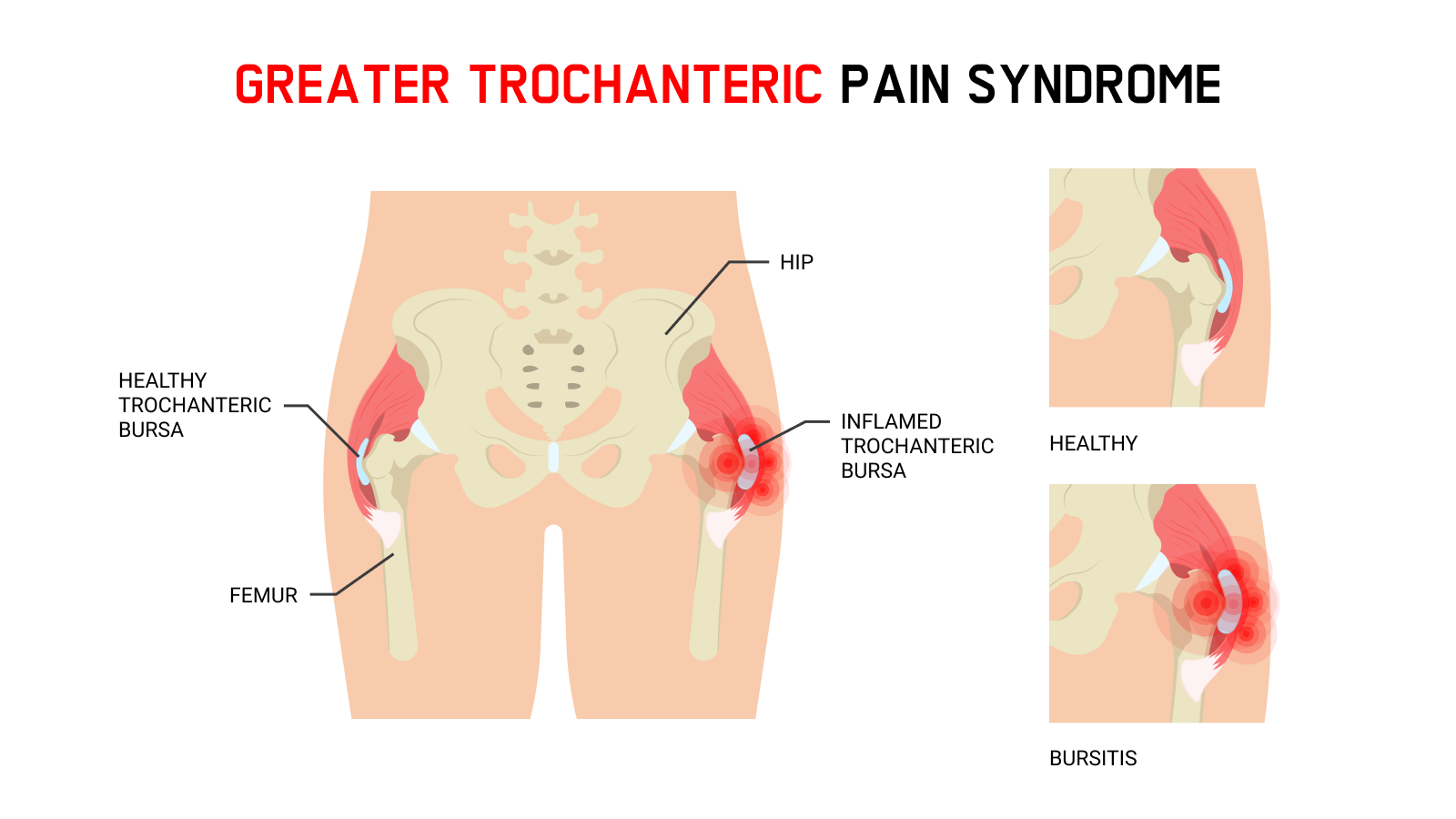 greater trochanteric pain syndrome main image anatomy