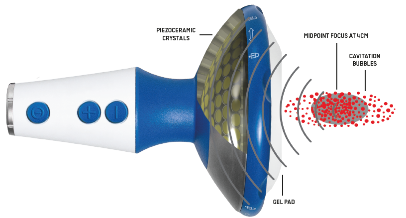 inside the focused shock waves handpiece 