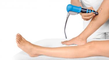 Medial tibial stress syndrome main picture