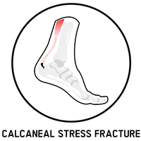 calcaneal stress fracture