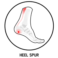 heel spur