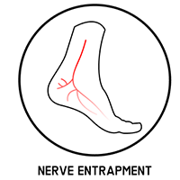 nerve entrapment