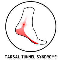 tarsal tunnel syndrome
